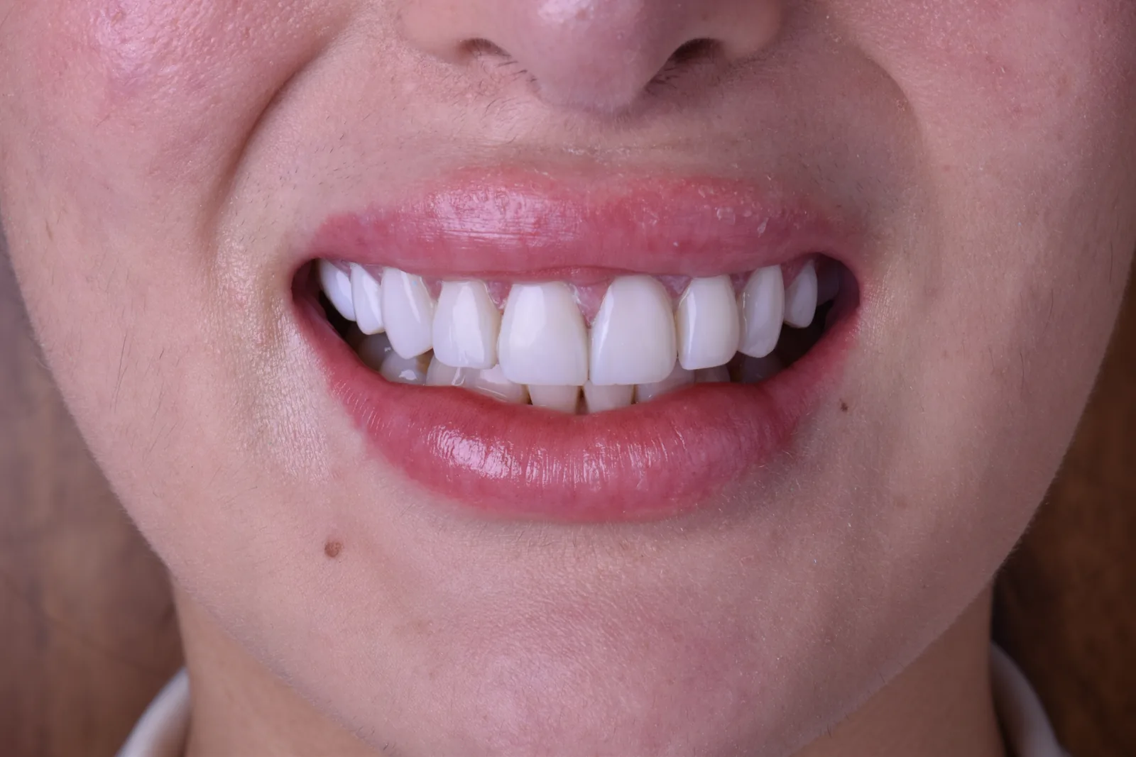 Después: sonrisa armónica tras carillas de porcelana superiores en Smile Atelier