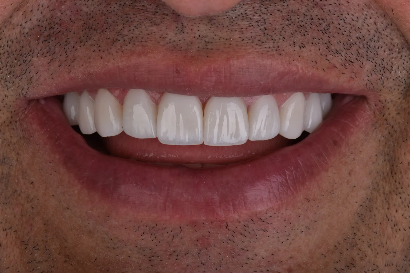 Después: rehabilitación completa con coronas de porcelana en Smile Atelier