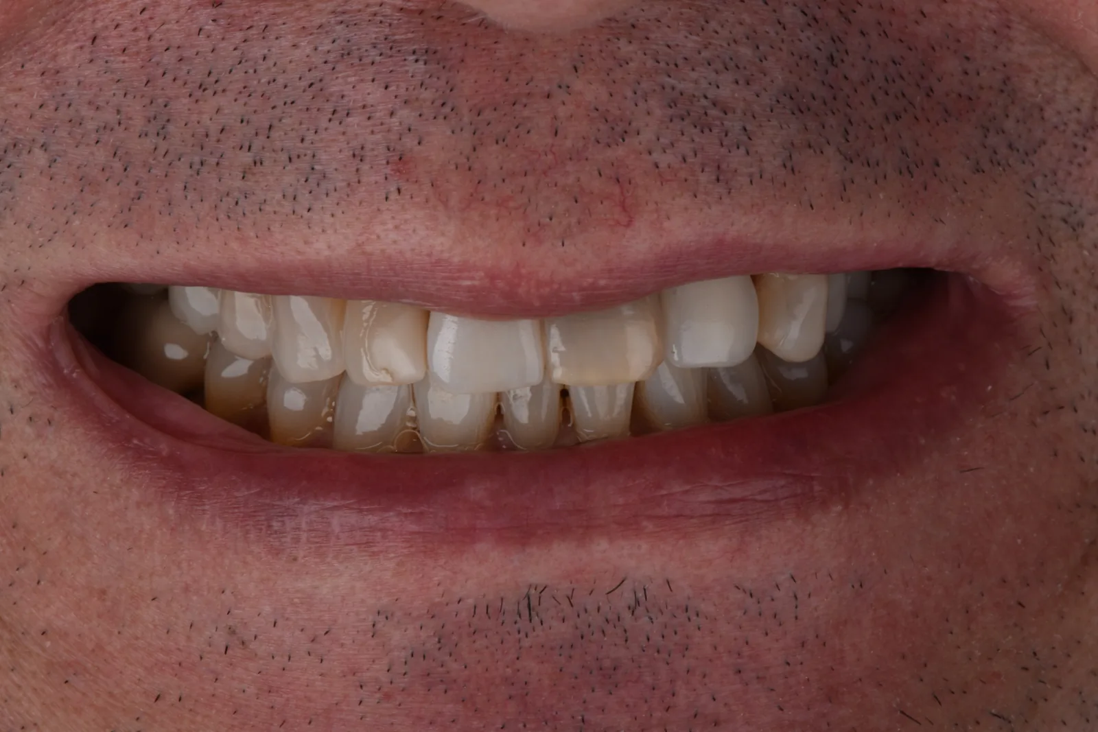 Antes: dientes desgastados e irregulares previos al tratamiento estético
