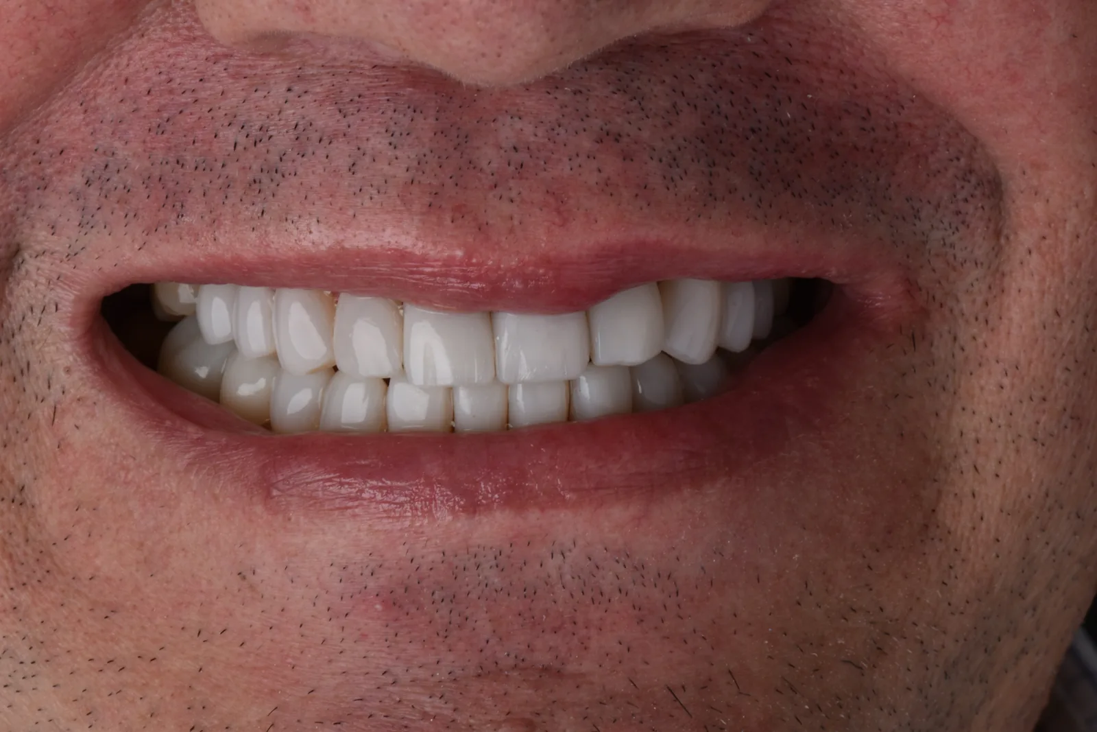 Después: sonrisa rejuvenecida con carillas y coronas en Smile Atelier